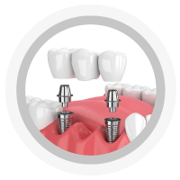 Prótesis Dental Parcial Fija