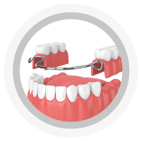 Prótesis Dental Parcial Removible