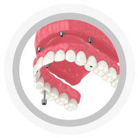 Prótesis Total Híbrida Sobre Implantes