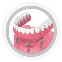 Prótesis Total Sobredentadura