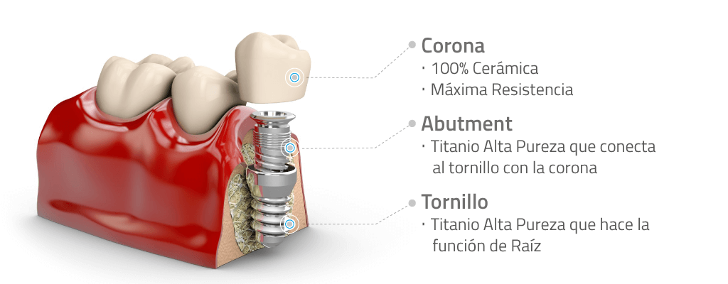 Materiales de un Implante Dental con Corona