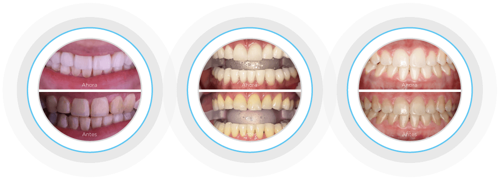 Blanqueamiento Dental que sí funciona