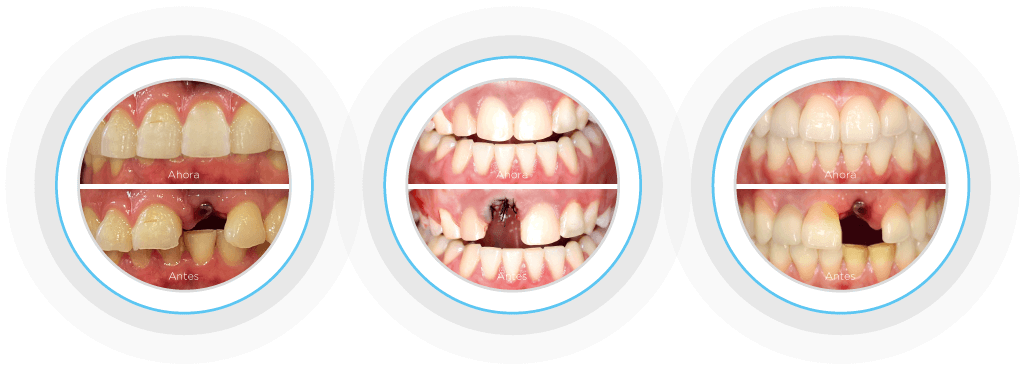 Implantes Dentales - Casos De Éxito Realaes