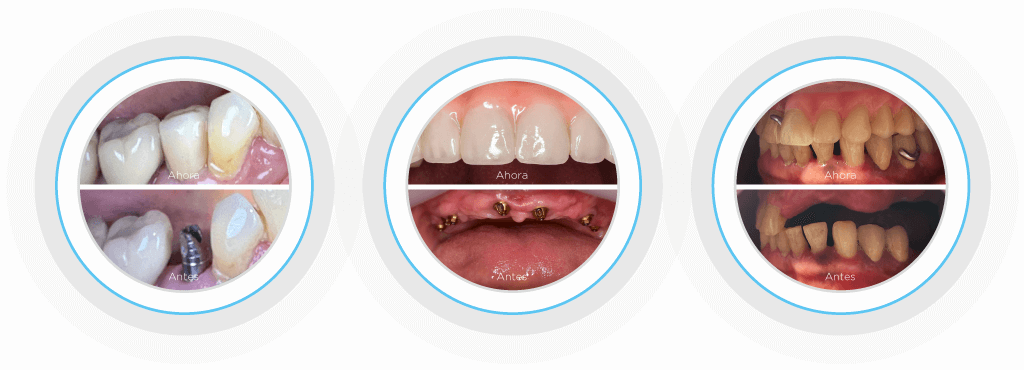Prótesis Dentales - Casos Reales