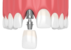 Implante Dental Fijo