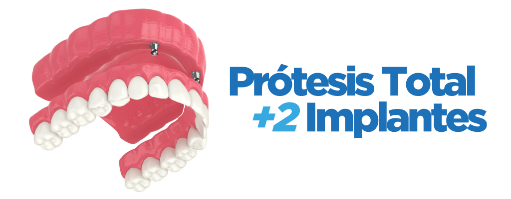 Prótesis Total Con 2 Implantes Dentales Tipo Clip´s