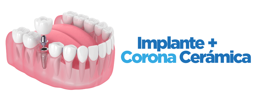 Implantes Dentales Con Corona Cerámica Incluida